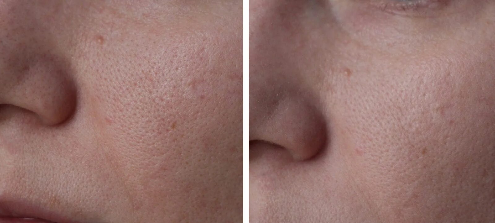 Умываться мылом от прыщей. Умывать лицо. Умываться мылом от прыщей. Умывание овсянкой до и после фото. Дегтярное мыло от угрей.