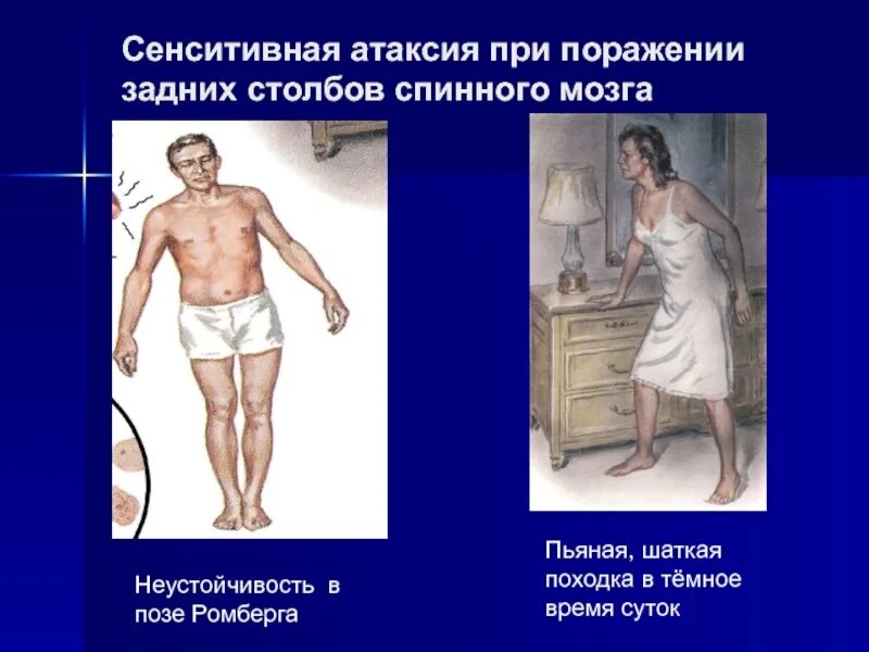 Шаткость походки симптом. Шаткая походка слабость. Сенситивная атаксия поза ромберга. Поза просителя при болезни паркинсона. Упражнения при панических атаках.