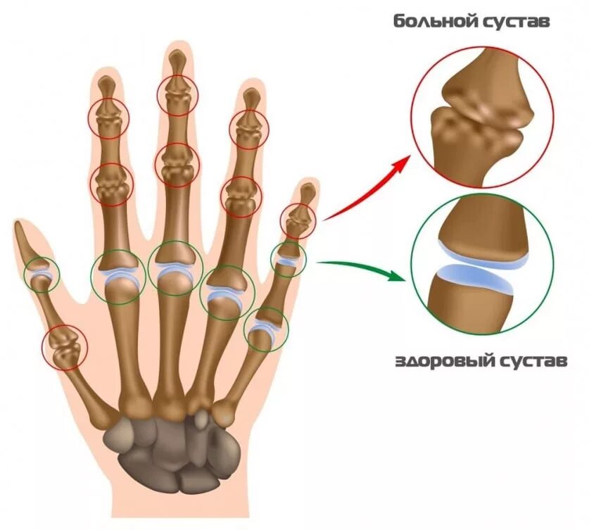 Болит основание сустава большого пальца. Ревматоидный артрит кисти. Артрит межфаланговых суставов кисти. Артроз межфаланговых суставов. Суставы пальцев рук анатомия.