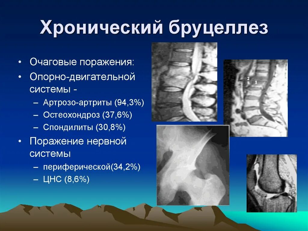 Что за болезнь бруцеллез у человека симптомы. Хронический бруцеллез.