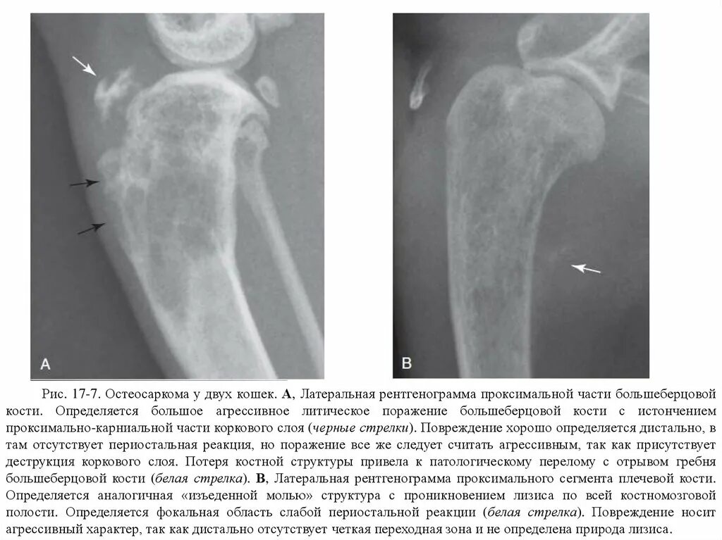 Рак в костях прогноз. Остеосаркома бедренной кости кт. Остеосаркома плечевой кости кт. Остеосаркома большеберцовой кости рентген.