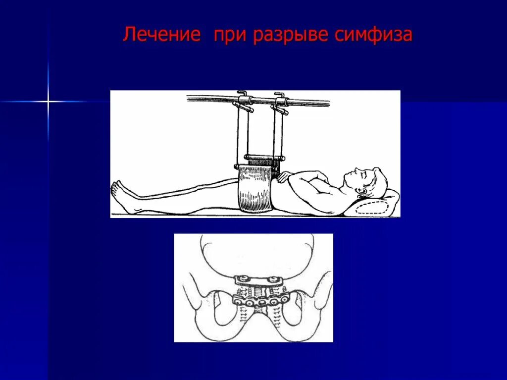 Разрыв сочленений. Разрыв лонного сочленения рентген. Аппарат наружной фиксации таза. Фиксация лонного сочленения.