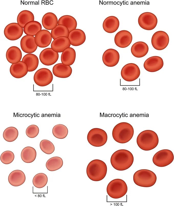 Анемия количество эритроцитов. Морфология эритроцитов при железодефицитной анемии. Морфология эритроцитов при анемиях. Размер эритроцитов при железодефицитной анемии. Изменение морфологии эритроцитов при железодефицитной анемии.