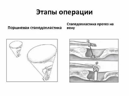 Стапедопластика