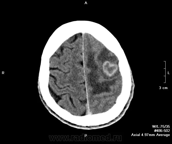 Туберкулома головного мозга кт. Туберкулема головного мозга на кт. Туберкулома головного мозга мрт. Туберкулома на кт.