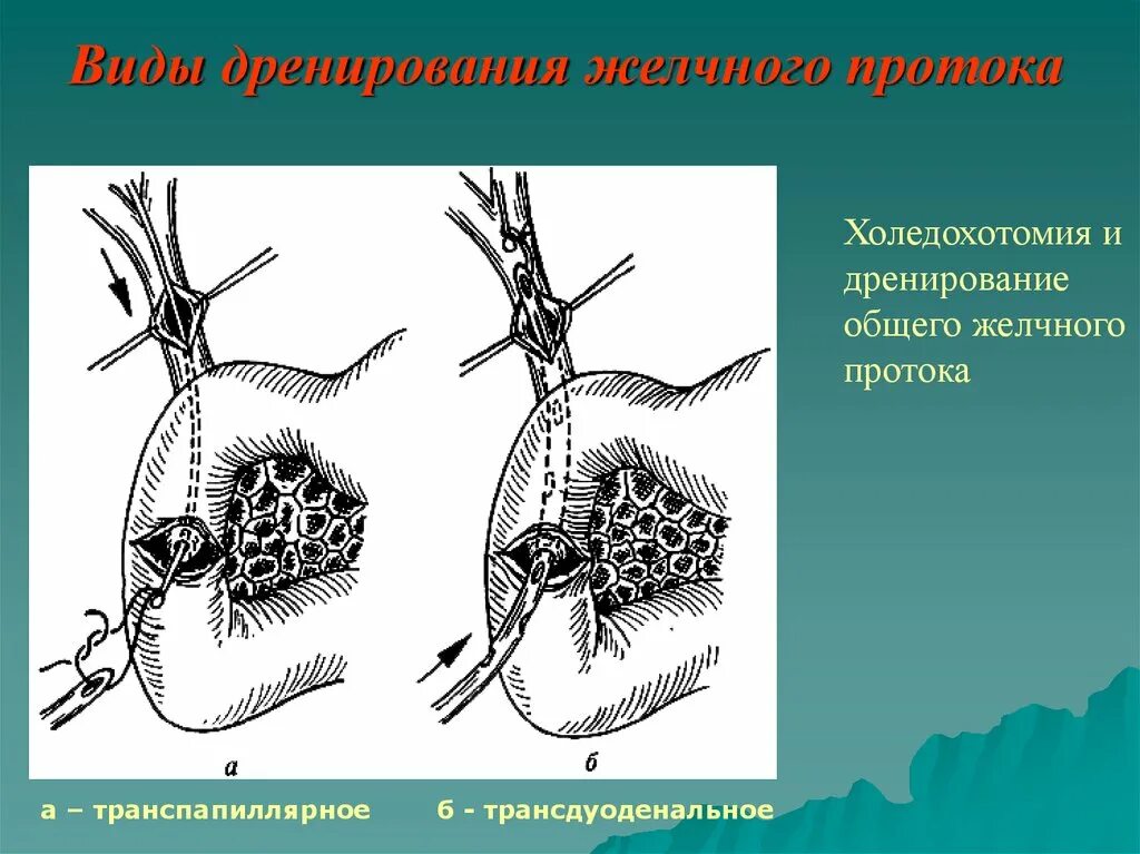 Катетер желчного пузыря. Дренирование желчных протоков. Ретродуоденальная холедохотомия. Дренирование общего желчного протока.