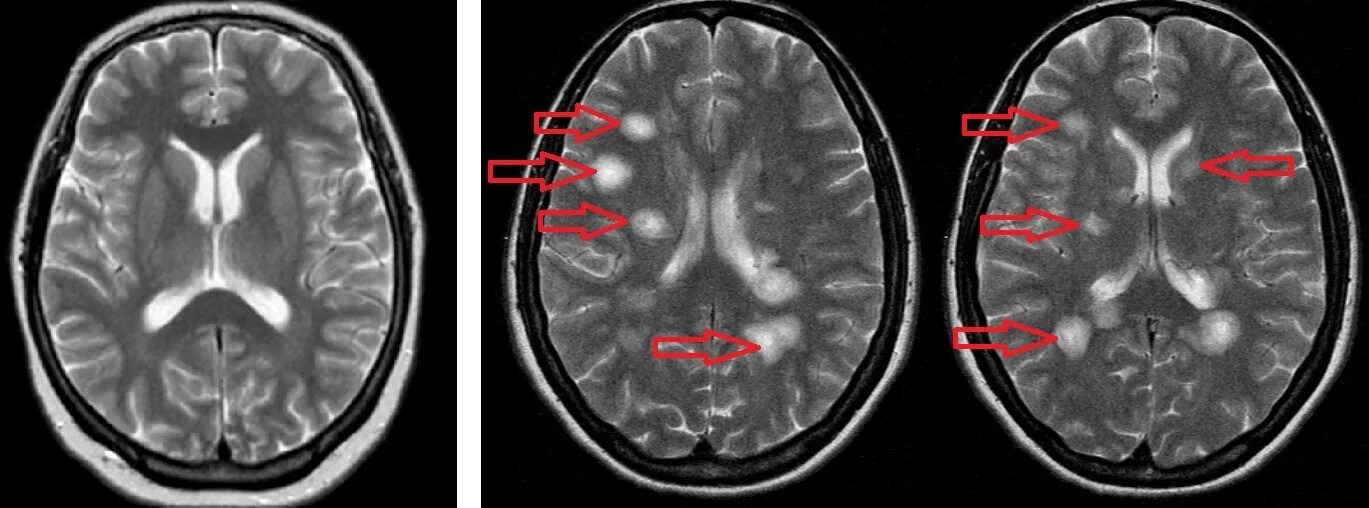 Рассеянный склероз на мрт головного мозга. Демиелинизирующее заболевание головного мозга мрт. Демиелинизирующее поражение спинного мозга мрт. Рассеянный энцефаломиелит мрт. Энцефалит головного мозга у взрослых