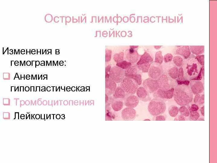 Лейкоз обострение. Острый лимфобластный лейкоз формула. острый лейкоз тромбоцитопения. острый лейкоз изменения в гемограмме. острый лимфобластный лейкоз гемограмма.