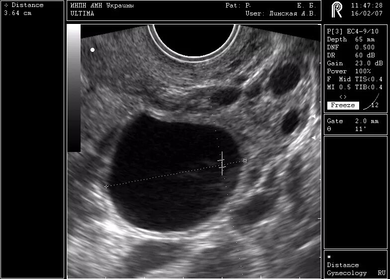 Узи овуляции форум. Фолликулометрия УЗИ доминантный фолликул. УЗИ мониторинг созревания фолликула. УЗИ яичников доминантный фолликул. Яйценосный бугорок на УЗИ.