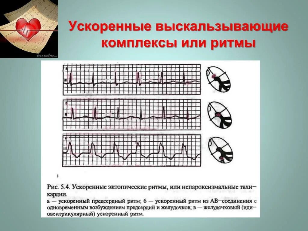 Медленные замещающие выскальзывающие ритмы ЭКГ. Эктопический предсердный ритм на ЭКГ. Медленные замещающие выскальзывающие комплексы и ритмы. Замещающий желудочковый ритм на ЭКГ. Эктопический предсердный ритм что это