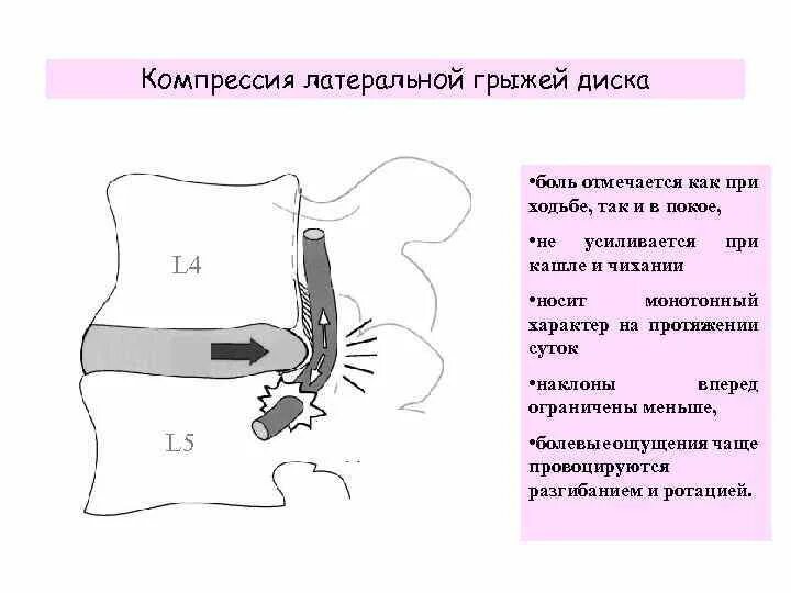Латеральная грыжа диска. Компрессия невральных структур позвоночника. компрессия нервалбнвх структур. при компрессии корешка отмечается:. латеральная компрессия.