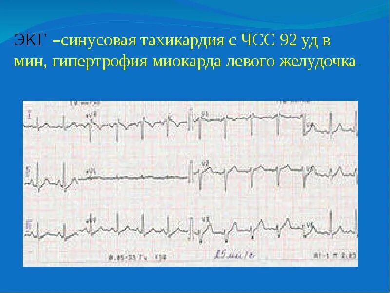 Пароксизмальная желудочковая на экг. Желудочковая тахикардия на экг. Пароксизмальная желудочковая тахикардия на экг. Пароксизмальная мерцательная тахикардия на экг. Пароксизм желудочковой тахикардии экг.