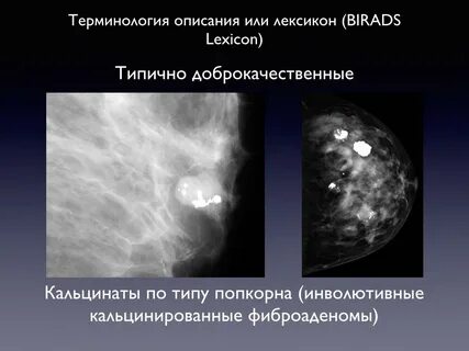 Фиброаденоматоз по типам