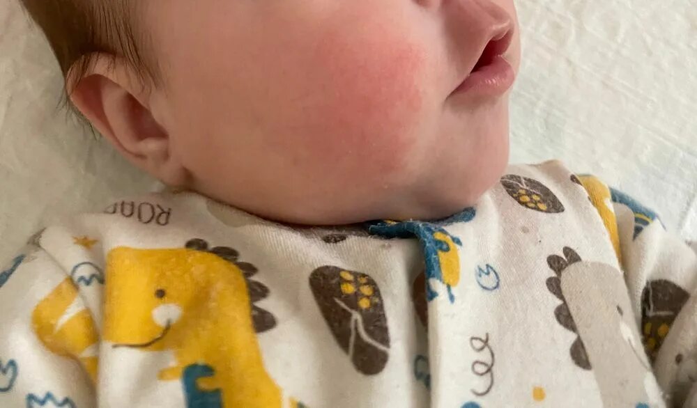 Рот в зубной пасте. Зубы аллергия. Зубы аллергия. Зубы аллергия. Аллергия к протезным материалам.