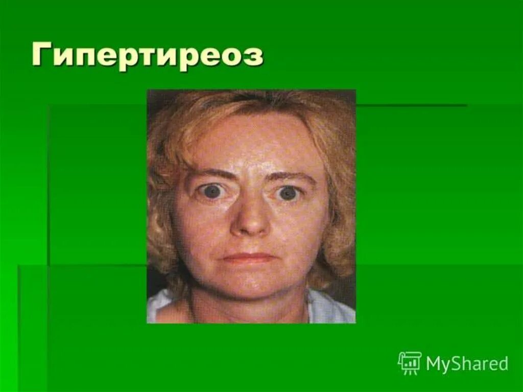 Гипертиреоз dr md ru. Гипертиреоз и тиреотоксикоз. Гипертиреоз у гипертиреоз.