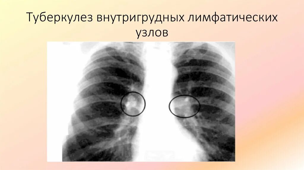 Малая форма туберкулеза внутригрудных лимфатических узлов рентген. Туберкулез внутригрудных лимфатических узлов рериген. Туберкулез внутригрудных лимфатических узлов рентген. Проявление туберкулеза внутригрудных лимфатических узлов рентген:. Лимфоузел в легком причина