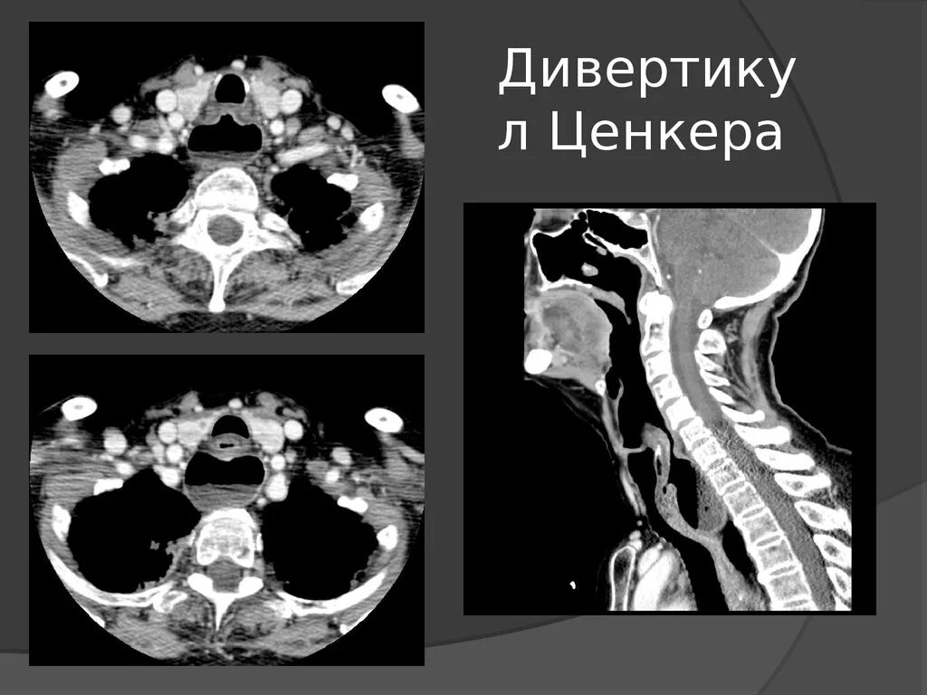 Дивертикул трахеи. Дивертикулы пищевода, дивертикул ценкера. дивертикул гортаноглотки - ценкера. дивертикул ценкера рентген.