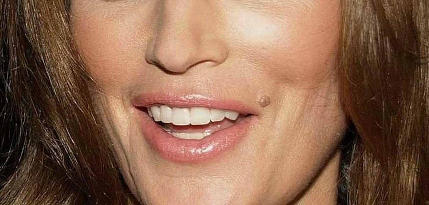 плоская бородавка на щеке. бородавки родинки на лице. бородавки родинки на лице.