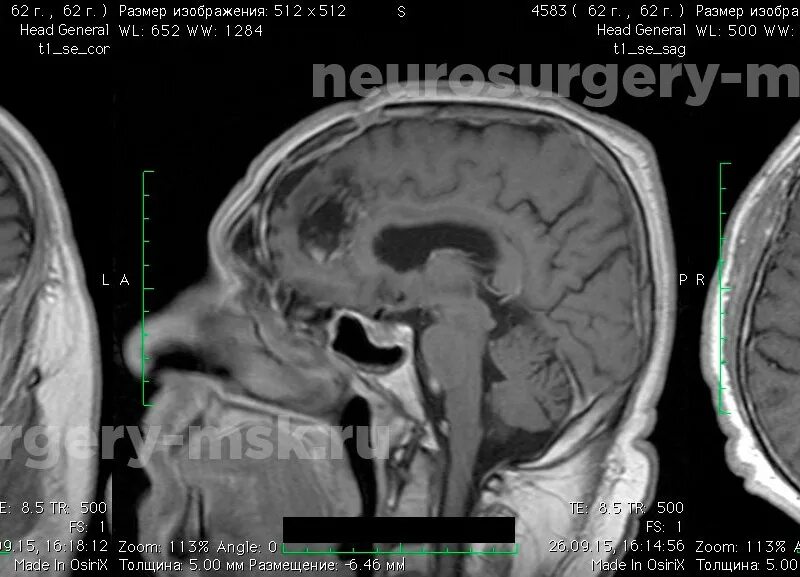Менингиома головного мозга кт. Фалькс менингиома головного. Фалькс менингиома кт. После операции менингиомы головного мозга