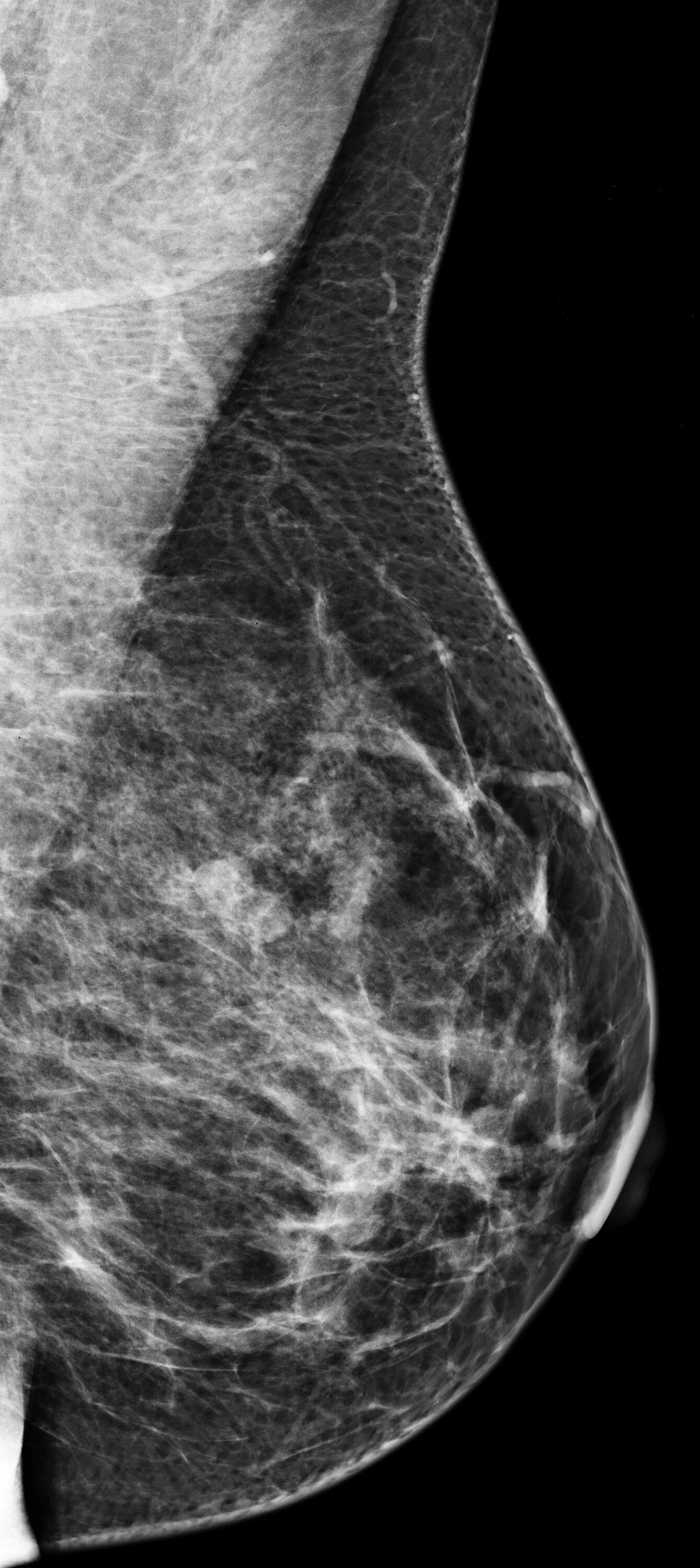 Мастопатия молочной железы на маммографии. Фиброзная мастопатия молочной железы маммография. Кистозная мастопатия маммография. Фиброзная мастопатия на маммографии. Лимфоузел молочной железы маммография