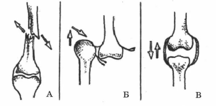 Вывих характеристика травмы. Повреждения скелета вывихи, растяжения, переломы. Вывих огэ. Повреждения скелета вывихи, растяжения, переломы. Презентация на тему вывихи.