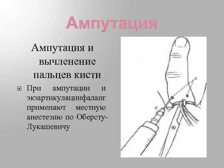 Ампутация фаланги кисти. Травматическая ампутация фаланги. Ампутация пальцев кисти. Ампутация первого пальца кисти.