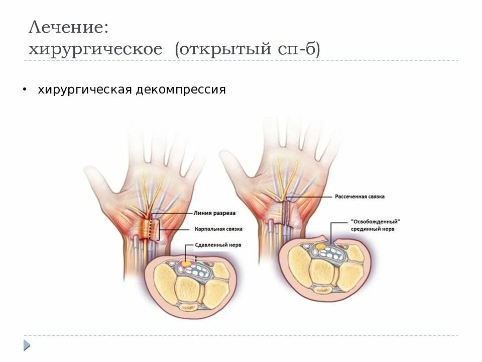 Туннельный синдром карпальный канал. Карпальный туннельный синдром реабилитация. Карпальный туннельный синдром кисти. Карпальный синдром руки.