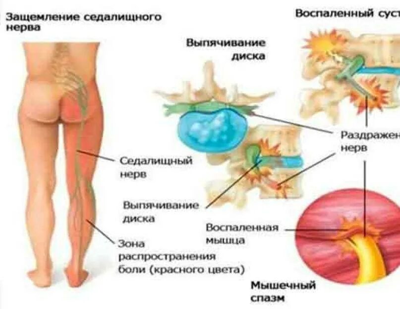 Нейропатия седалищного нерва. Воспаление и защемление седалищного нерва. Уколы от защемления седалищного нерва. Препараты от воспаления седалищного нерва.