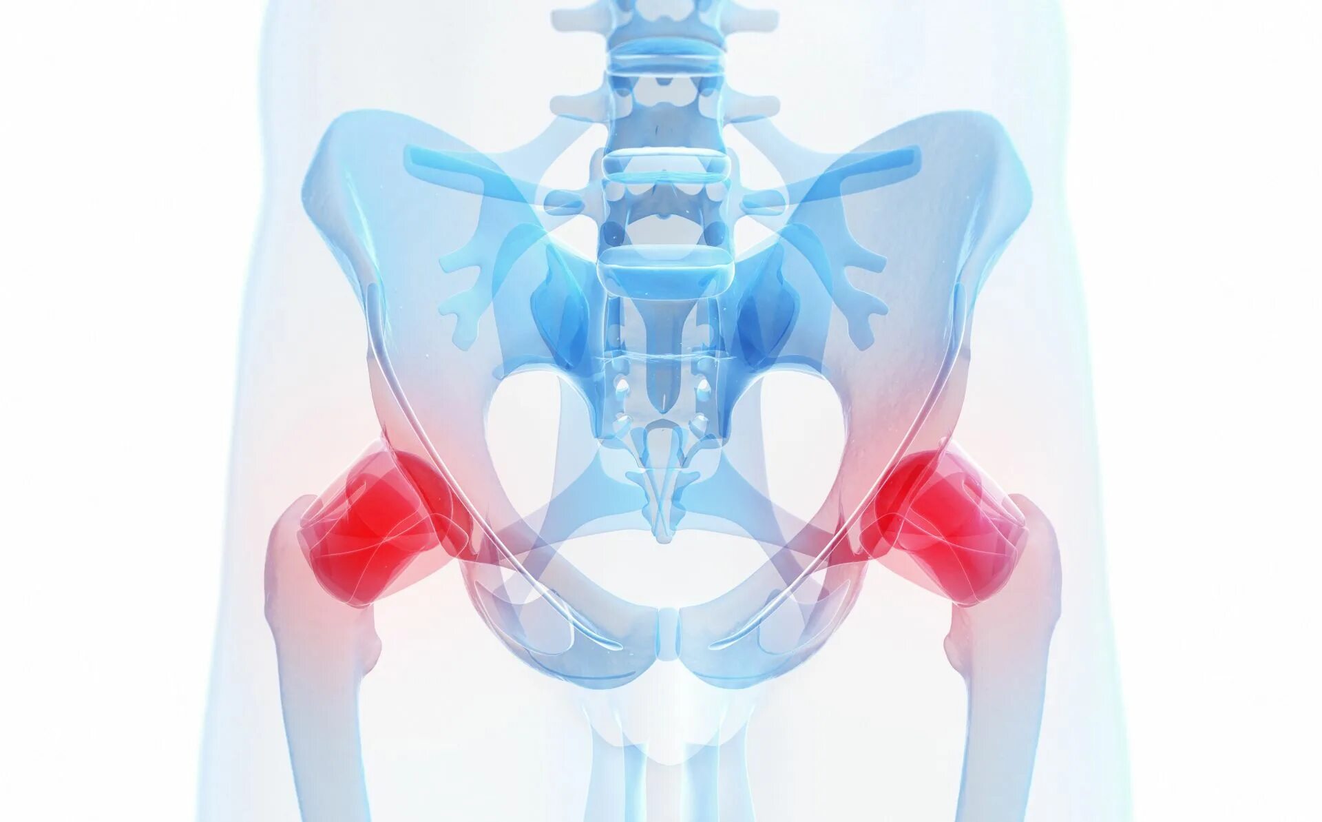 Коксартроз тазобедренного сустава рентген. Артралгия тазобедренного сустава. Седалищный бурсит тазобедренного. Медицина суставы тазобедренный