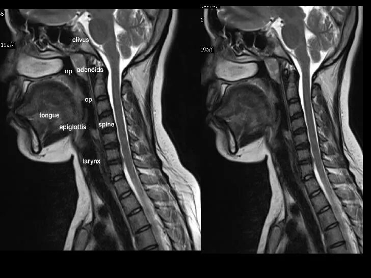 Грушевидные синусы гортани на кт. Кт горла что показывает. Кт горла что показывает. Асимметрия грушевидных синусов кт. Кт горла что показывает.