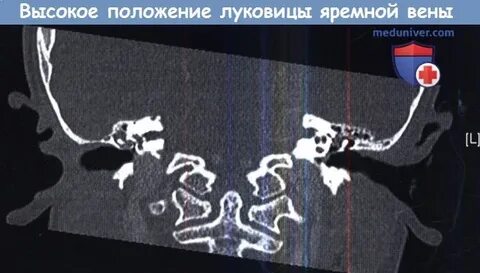 Верхняя луковица яремной