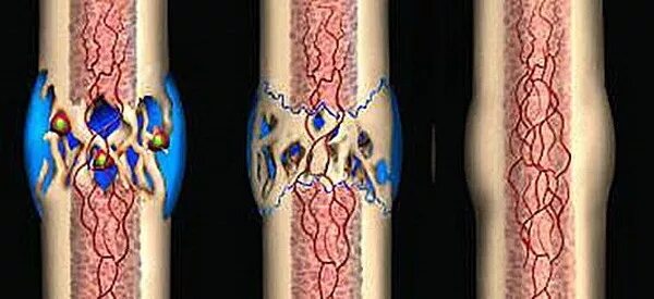 Трещина заживает. Регенерация кости после перелома. Заживление перелома кости. Регенерация костной ткани. Процесс заживления кости после перелома.