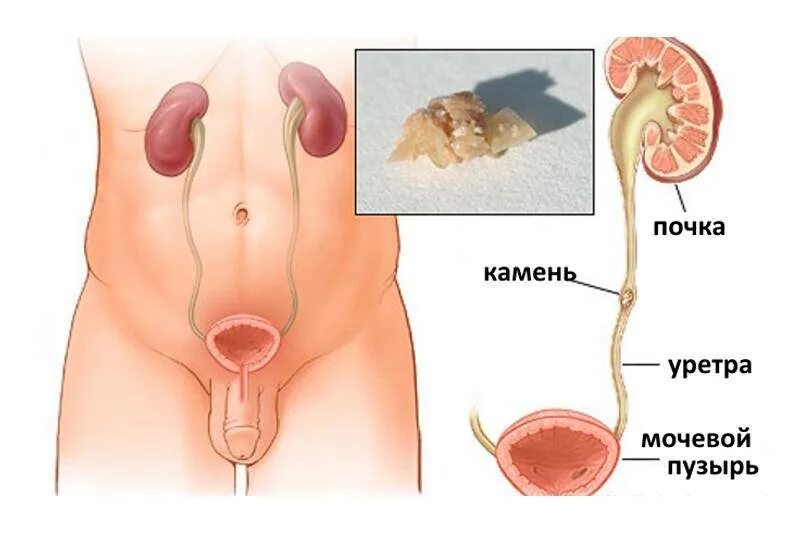 Камень выходит из почки симптомы у мужчин. Мочевой камень в уретре. камни в мочеточнике уретре. камень в мочеточнике у мужчин. камень из мочеточника у мужчин.