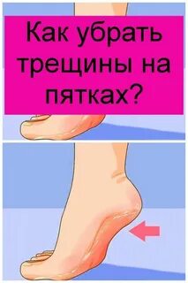 Что делать треснула пятка больно ходить