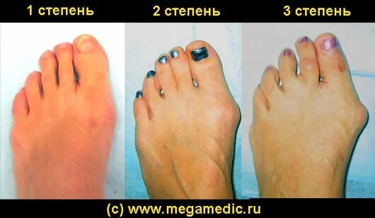 йод при вальгусной деформации стопы. осложнения операции вальгусной деформации большого пальца. вальгусная деформация по омс. операция по удалению косточки на ноге. вальгусная деформация большого пальца.