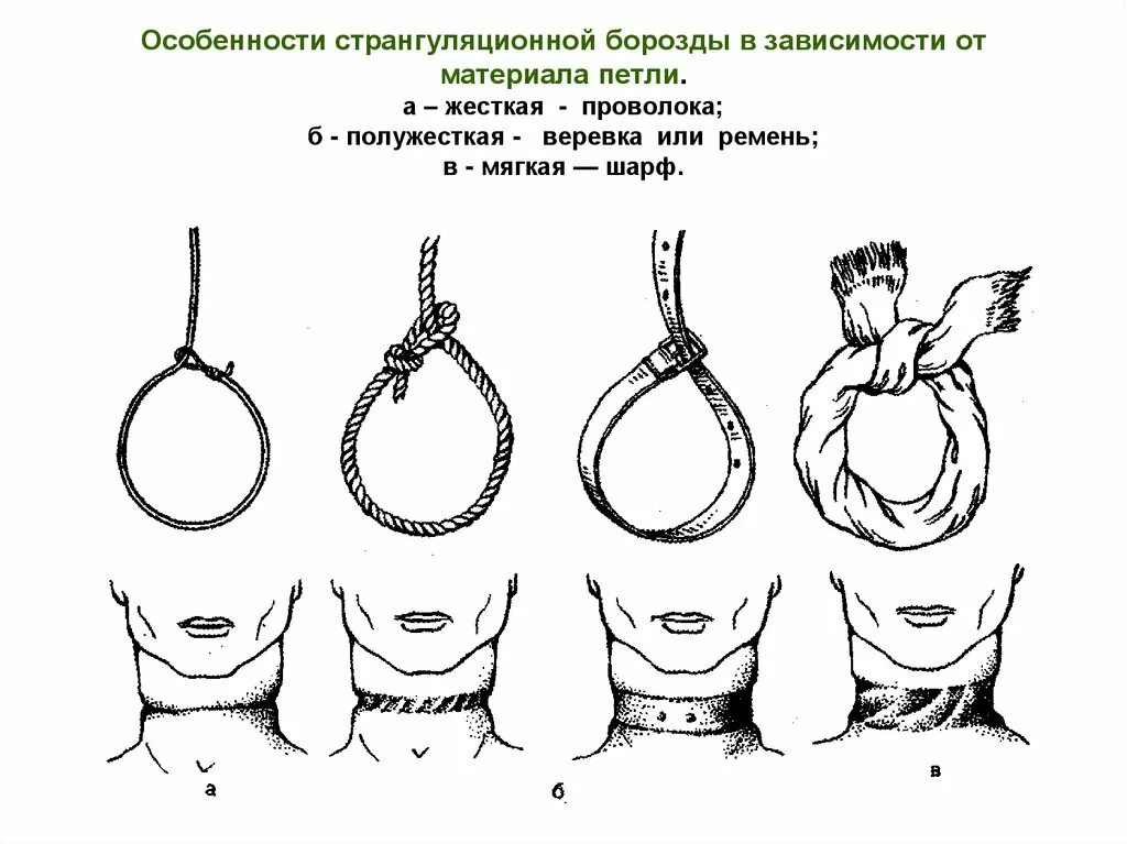 Повешение борозда. Странгуляционная борозда. странгуляционная борозда на шее. странгуляционная борозда виды. странгуляционная полоса.