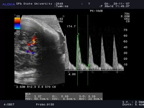 легочная эмболия причины. узи кровоток в средней мозговой артерии. проба вальсальвы варикоцеле. синдром позвоночной артерии на узи. магистрально измененный кровоток по узи.