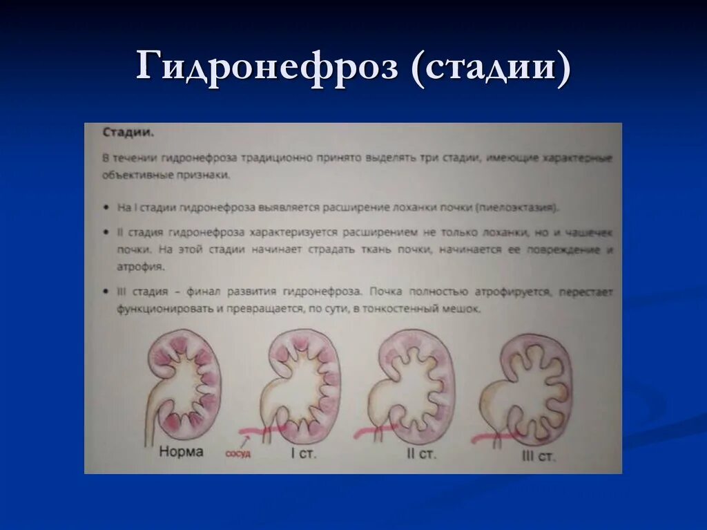 Гидронефроз почки классификация. УЗИ почек гидронефроз 1ст. Гидронефроз УЗИ классификация. Расширение лоханки у ребенка