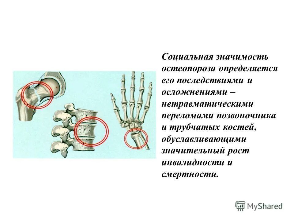 Компрессионный перелом тела т11 позвонка. Перелом позвонка инвалидность. Компрессионные переломы позвонков т11. Огнестрельное ранение позвоночника. Перелом позвонка инвалидность.