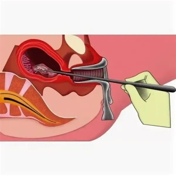 Как происходит выскабливание. Раздельное диагностическое выскабливание (РДВ). Выскабливание полости матки инструментарий диагностическое. Аспирационный кюретаж полости матки. Выскабливание слизистой оболочки матки.