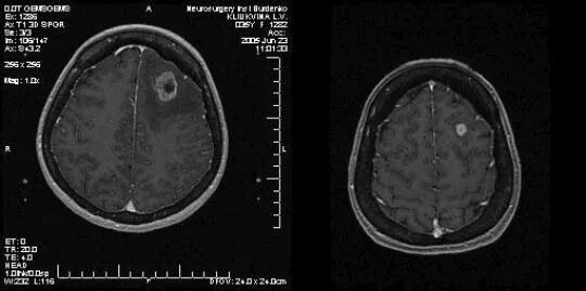 Меланома метастазы в мозг