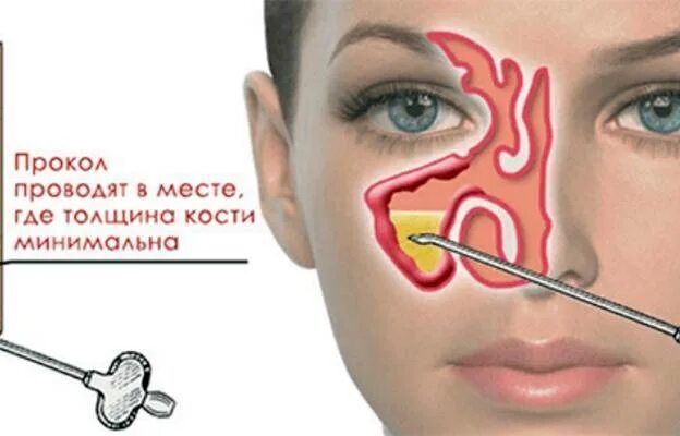 Можно ли вылечить гайморит без прокола