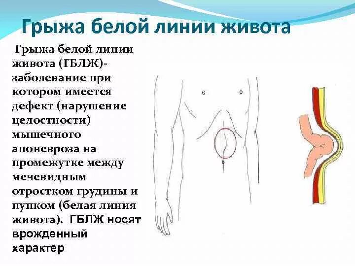 Параумбиликальная грыжа живота. Грыжи пупочные и белой линии живота. Грыжевое выпячивание передней брюшной стенки. Эпигастральная вентральная грыжа.