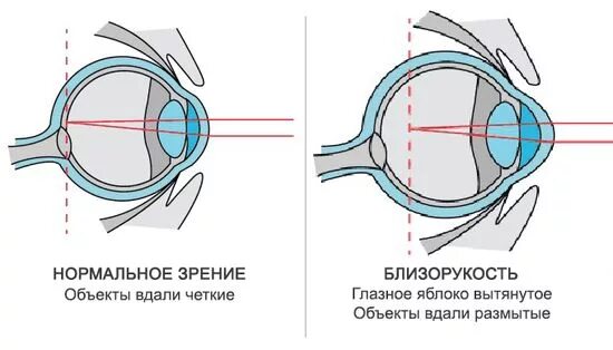 Удлиненное глазное яблоко близорукость. Дальнозоркость и близорукость строение глаза. Схема глазного яблока при близорукости. Близорукость строение глаза. Нормальный глаз схема