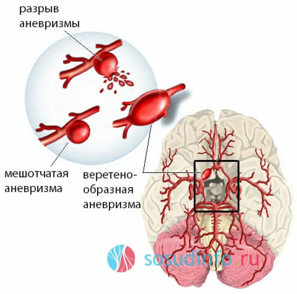 Мешотчатая аневризма сосудов головного мозга. Аневризма среднемозговой артерии. Аневризмы средней мозговой артерии. Аневризма передней мозговой артерии головного мозга. Аневризма мозга простыми словами