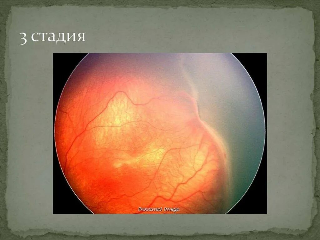 Ретинопатия недоношенных 1 степени. Альбуминурическая ретинопатия. Факторы риска ретинопатии недоношенных. Ретинопатия недоношенных. Ретинопатия новорожденных офтальмология.