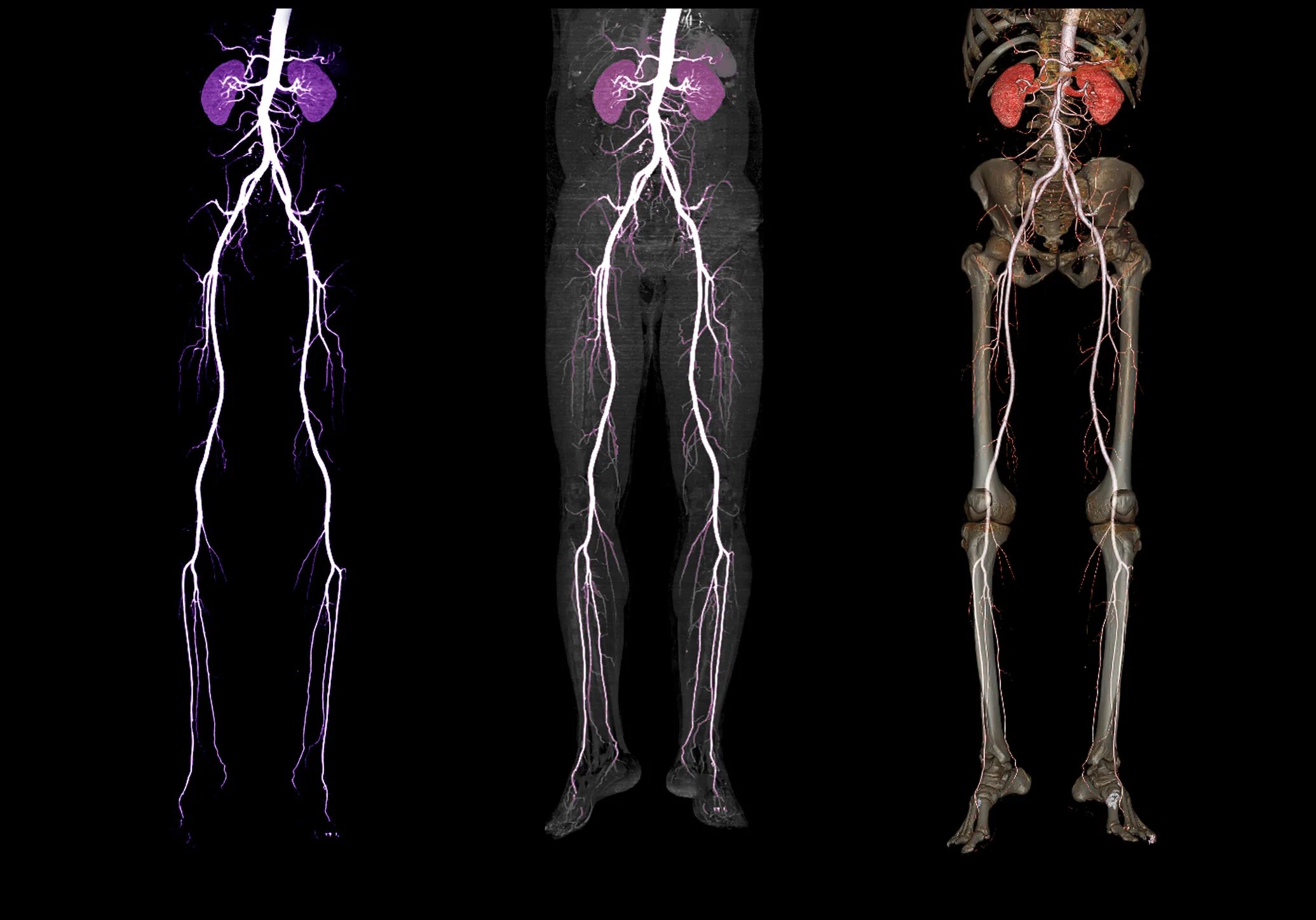 Нижних конечностей и головного мозга. Кт ангиография нижних конечностей. Кт-ангиография артерий нижних конечностей. Ангиография периферических артерий. Магнитно-резонансная ангиография сосудов нижних конечностей.