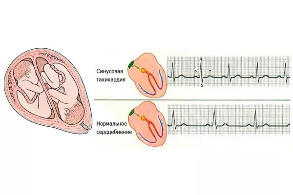 Синусовая тахикардия при беременности 1 триместр. Синусовая тахикардия при беременности 3 триместр. Тахикардия у беременных 2 триместр. Синусовая тахикардия у беременных 2 триместр. Пульс в 3 триместре
