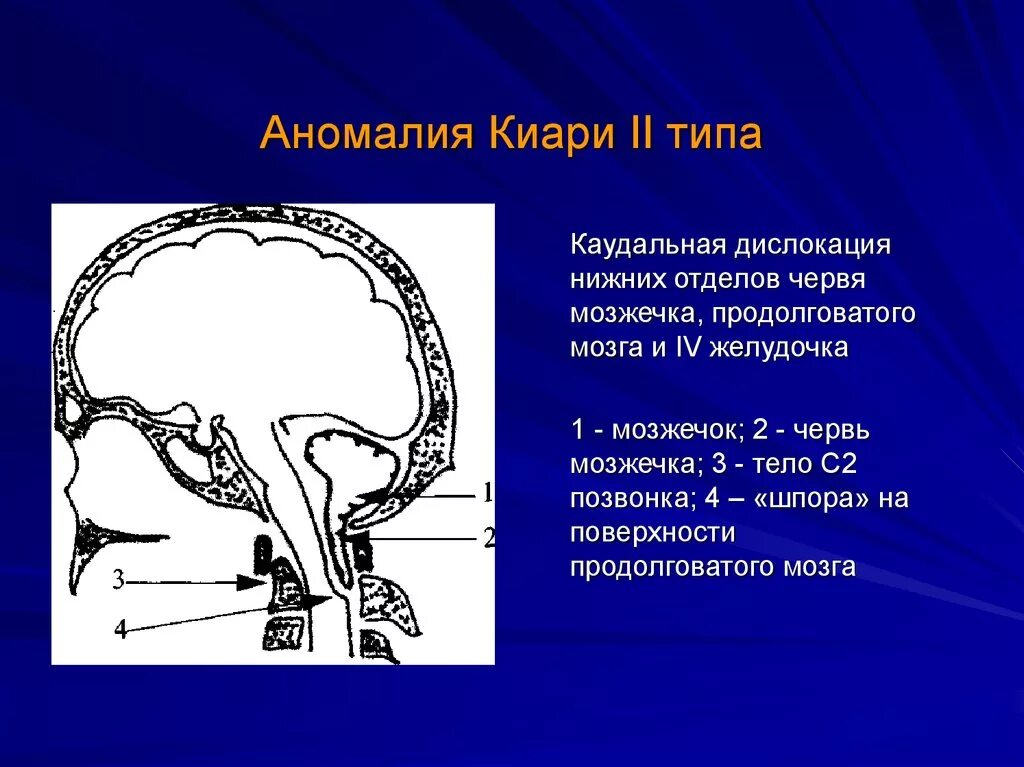 Аномалия арнольда киари что это простыми. Аномалия Арнольда Киари мозжечок. Эктопия миндалин мозжечка кт. Мальформация Киари 1 типа.