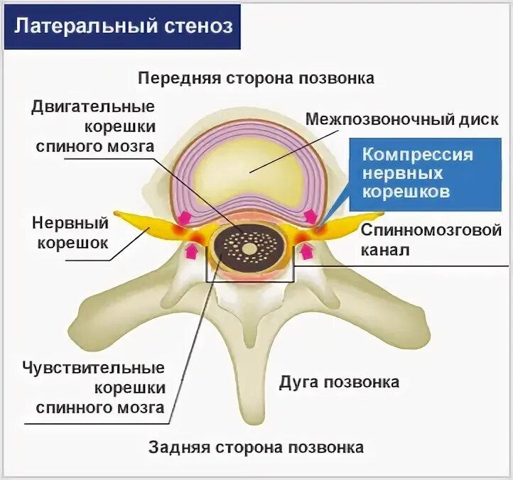 Латеральный стеноз позвоночного канала. Латеральный карман позвоночного канала. Дегенеративный стеноз позвоночного канала. Позвоночный канал сужен.